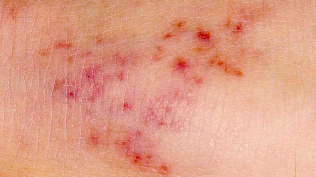 Is it good for a rash to blanch?