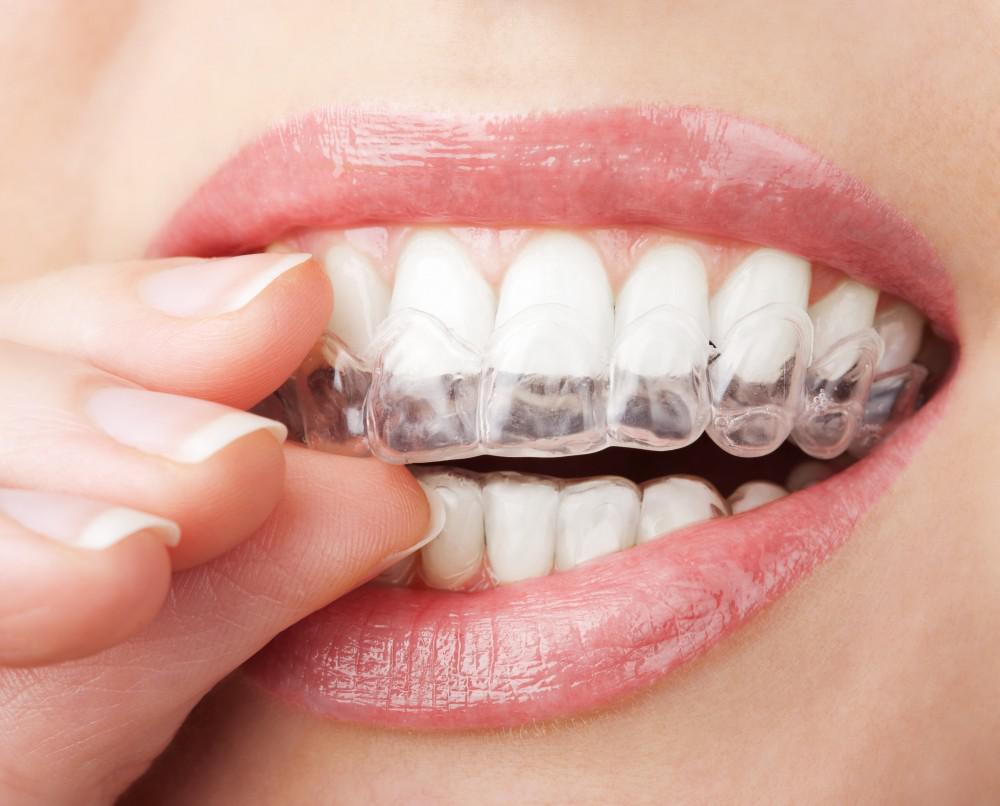 What happens if you change Invisalign trays too soon